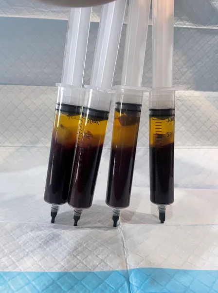 Inspection visuelle des caillots sanguins vivants vaccinés contre le C19 – Substance semblable à du caoutchouc (hydrogel) détectée – Méfiez-vous des images graphiques